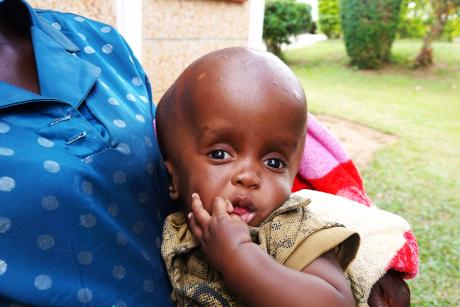 Baby Reagan Mwizukye received the life-saving surgery at Cure Children's Hospital of Uganda
